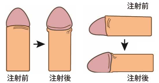 亀頭増大注射の施術前後のイメージ
